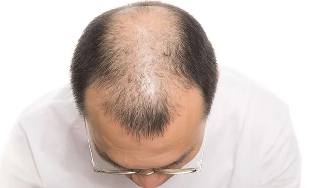 男性型脱毛症（AGA）